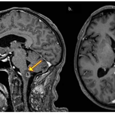 A 66 Year Old Male Patient Diagnosed With Cryptococcal Meningitis And