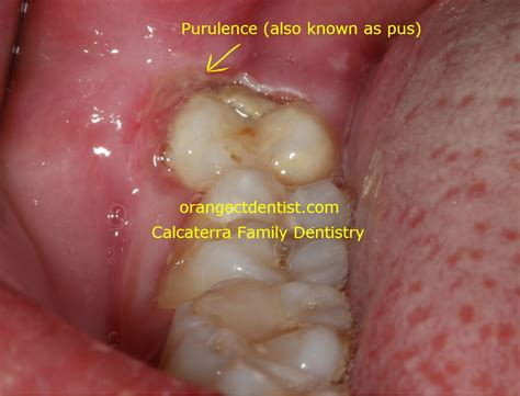 Pericoronitis