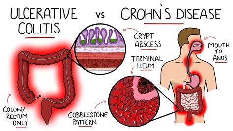Inflammatory Bowel Disease Ulcerative Colitis V Crohn S Disease With Histology