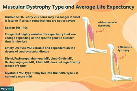 Muscular Dystrophy Life Expectancy Type And Prognosis