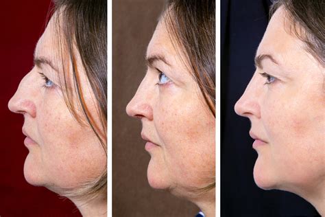 Kybella A Revolutionary New Treatment For Double Chin Mcrae Md