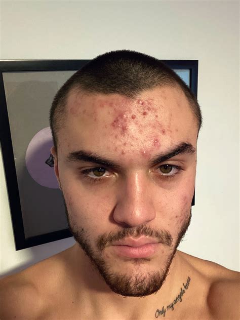 Grayson Dolan Speaks Out After Fans Call Ethans Acne Ugly