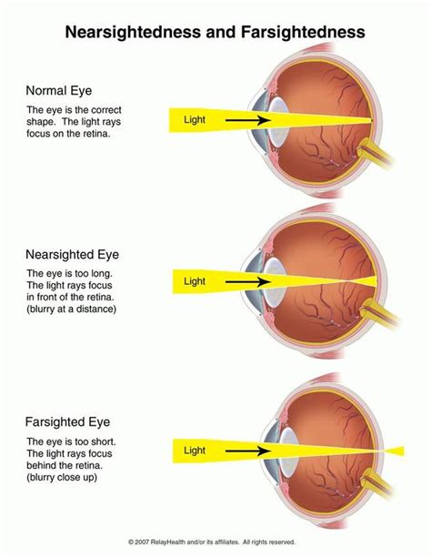 Nearsightedness And Farsightenedness Light Rays The Retina Anatomy