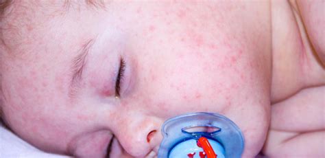 8 Ways To Take Care Of Atopic Dermatitis In Kids All Answers