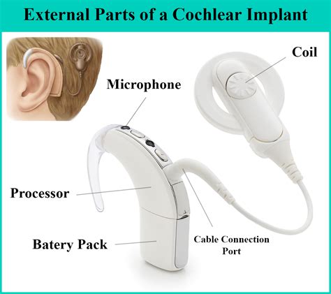 List Pictures Photos Of Cochlear Implants Full Hd K K