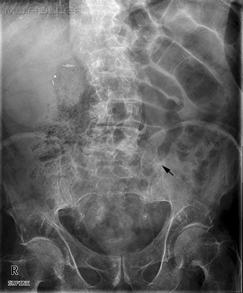 List 92 Pictures Pictures Of Hernias In The Stomach Latest 102023