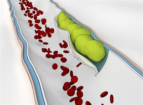 What Is Small Vessel Ischemia? (with pictures)