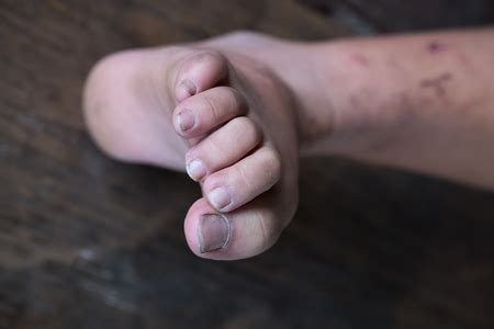 S Hammertoe Foot Toe Injury Your Next Step Podiatry
