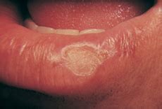 Stage 0 mouth cancer stage 0 is also called carcinoma in situ, and this is the very beginning of the scale. Oral Cancer Facts - Navarro Dental Group