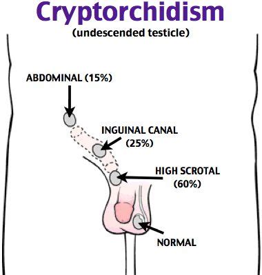 Its hypoplasia (or half) is revealed, the absence of a cremaster reflex. Cryptorchidism Rosh Review | Pediatrics EORE | Pinterest