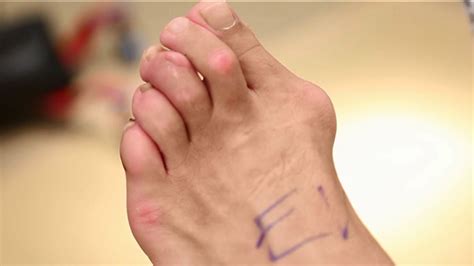 New Bunion Surgery Cuts Recovery Time