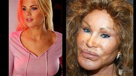 10 Celebrity Before And After Plastic Surgery Disasters Flickr