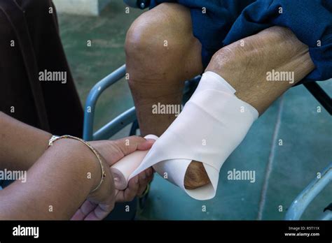 Elastic Bandaging Of Below Knee Stump Stock Photo Alamy