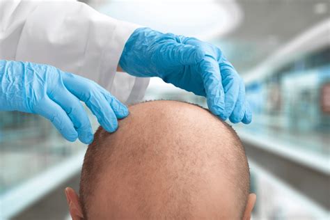 Everything You Need To Know About The NeoGraft Hair Transplant