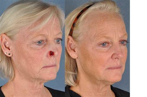 Before And After Gallery Denver Co Cherry Creek Face And Skin