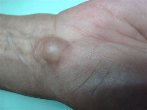 How I Treated a 66-year-old Female with Ganglion Cyst on the Wrist