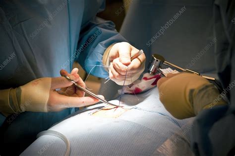 Slipped Disc Microendoscopy Surgery Stock Image C0049405 Science