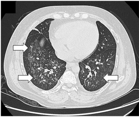 Pneumocystis Jirovecii Pneumonia High Resolution Ct Sc