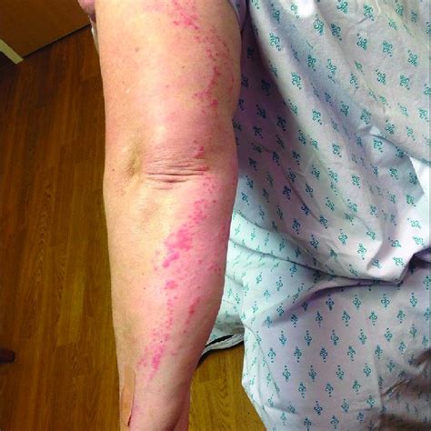 Pdf A Case Of Linear Cutaneous Lupus Erythematosus In A 55 Year Old Woman