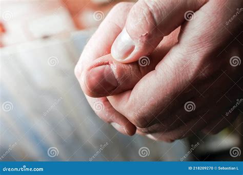 Guy Holding His Bitten Bleeding Thumb Hands Have Dry Skin Stock Photo