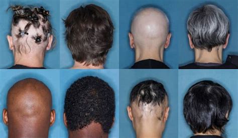Successful Alopecia Areata Drug Trials Hpihair Partners