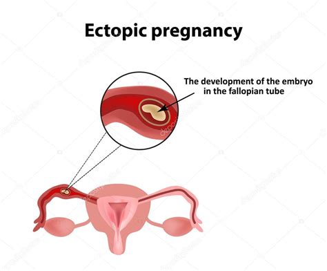 Ectopic Pregnancy The Embryo In The Fallopian Tube Infographics