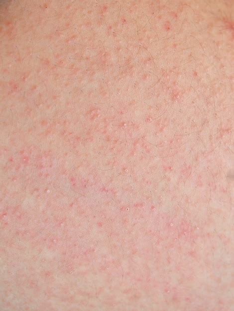 Allergic Dermatitis Skin Rash