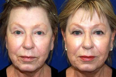 Lunch Hour Facelift Before And After Photos Facelift Info Prices