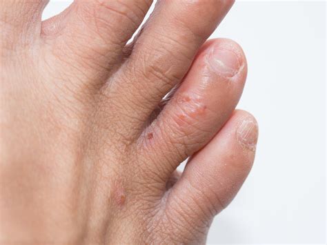 Dyshidrosis โรคผิวหนังอักเสบ ตุ่มน้ำใสที่มือ คันมืออย่างมาก รักษา