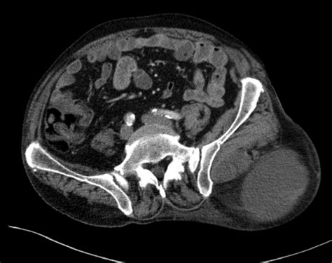 Myxofibrosarcoma Ct Aspect Of The Cranial Pole Of The Buttock Tumor