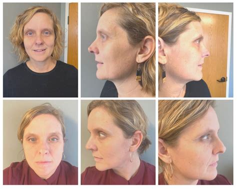 Facial Acupuncture Treatments I Tried Facial Rejuvenation Acupuncture