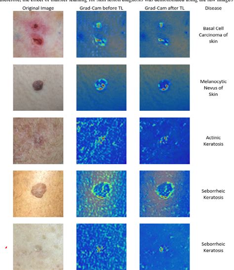 Figure 4 From Skin Lesion Classification Using Cnn Based Transfer