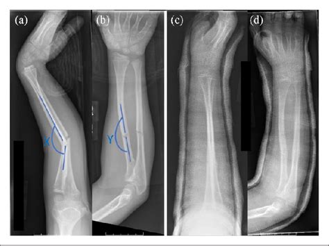 A B A 7 Year Old Female With A Proximal Third Diaphyseal Radius