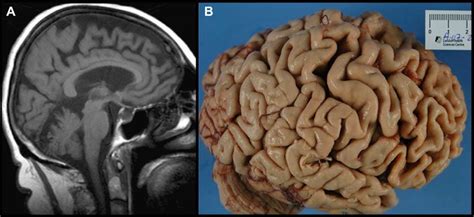 View of a patient with bvFTD showing a unique pattern of brain atrophy ...