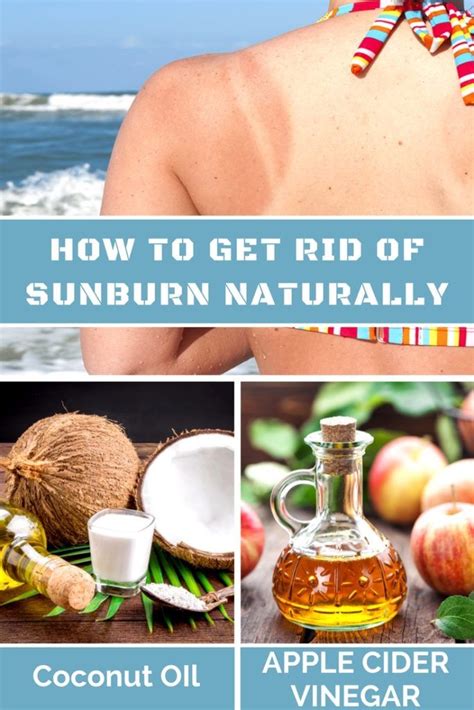 10 Ultimate Home Remedies To Get Rid Of Sunburn Overnight Natural