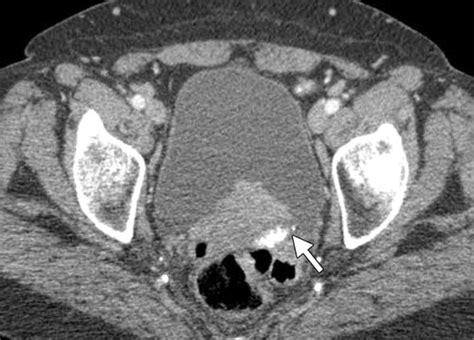 Urinary Bladder Cancer Role Of Mr Imaging Radiographics