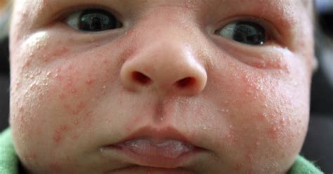 Baby Acne Cure And Treatment Babies Acne Treatment Simple Ways To