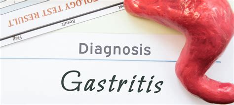 Gastritis Causes Symptoms Dignosis Treatment Gidoc Johannesburg