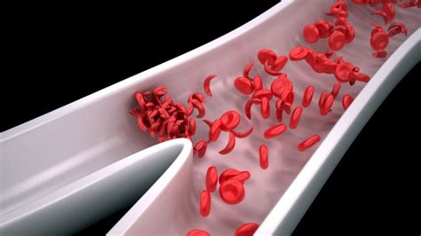 Chop Researchers Make Progress On Sickle Cell Disease Treatment Whyy