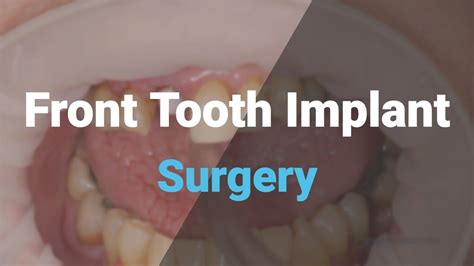Tooth Extraction And Immediate Implant Placement Youtube