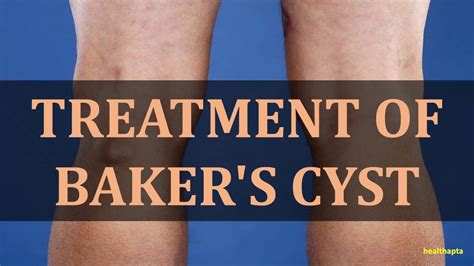 Treatment Of Bakers Cyst Youtube