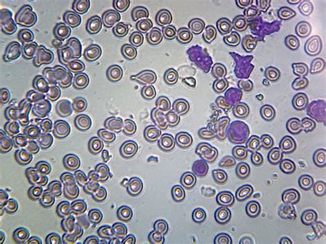 Acute Lymphatic Leukemia Smear From Blood Gs Stain Showing