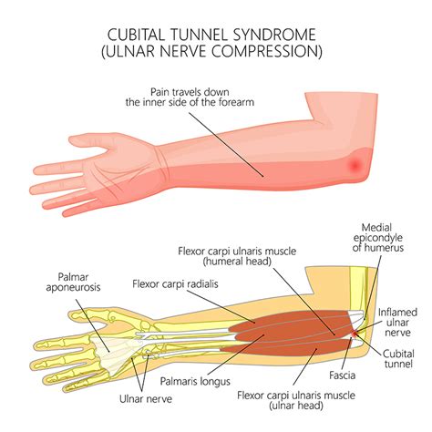 Hand Wrist And Elbow Fremont Orthopedic And Rehabilitation Medicine