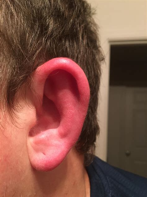 What Would Cause My Ears To Get Red And Hot To The Touch Its