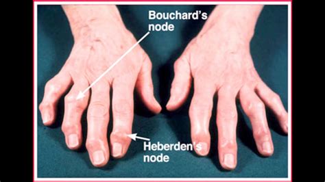 Arthritis Overview Raoawhat To Avoid Youtube