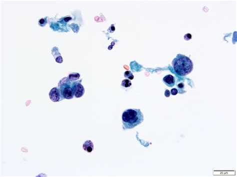 Pathology Outlines Neoplastic Urine Cytology
