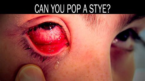 No insurance necessary without leaving your home. Should i pop my stye > ALQURUMRESORT.COM