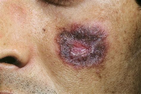 Lupus Erythematosus On The Face Stock Image C0131024 Science