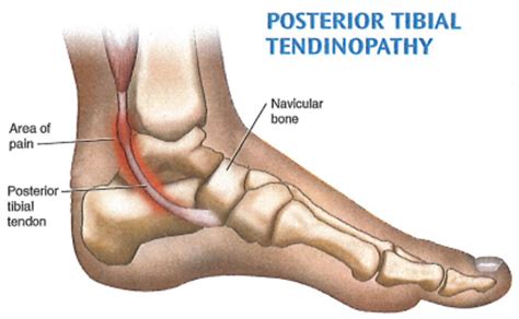 Posterior Tibial Tendonitis And Tendinopathy Causes Symptoms