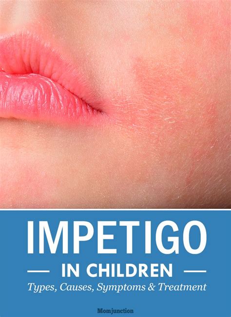 Impetigo In Children Symptoms Treatment And Prevention Artofit